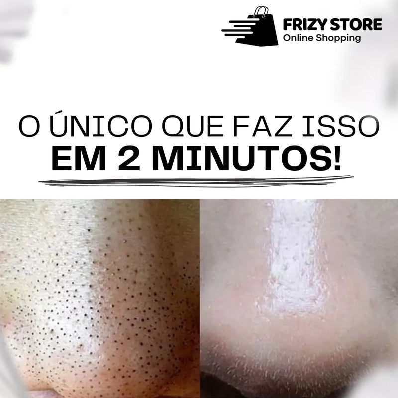 Kit Tira Cravos Lanbena® - Remoção em 2 minutos!