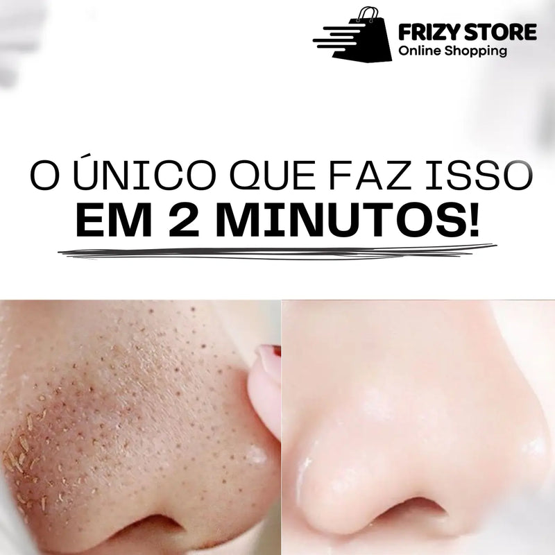 Kit Tira Cravos Lanbena® - Remoção em 2 minutos!